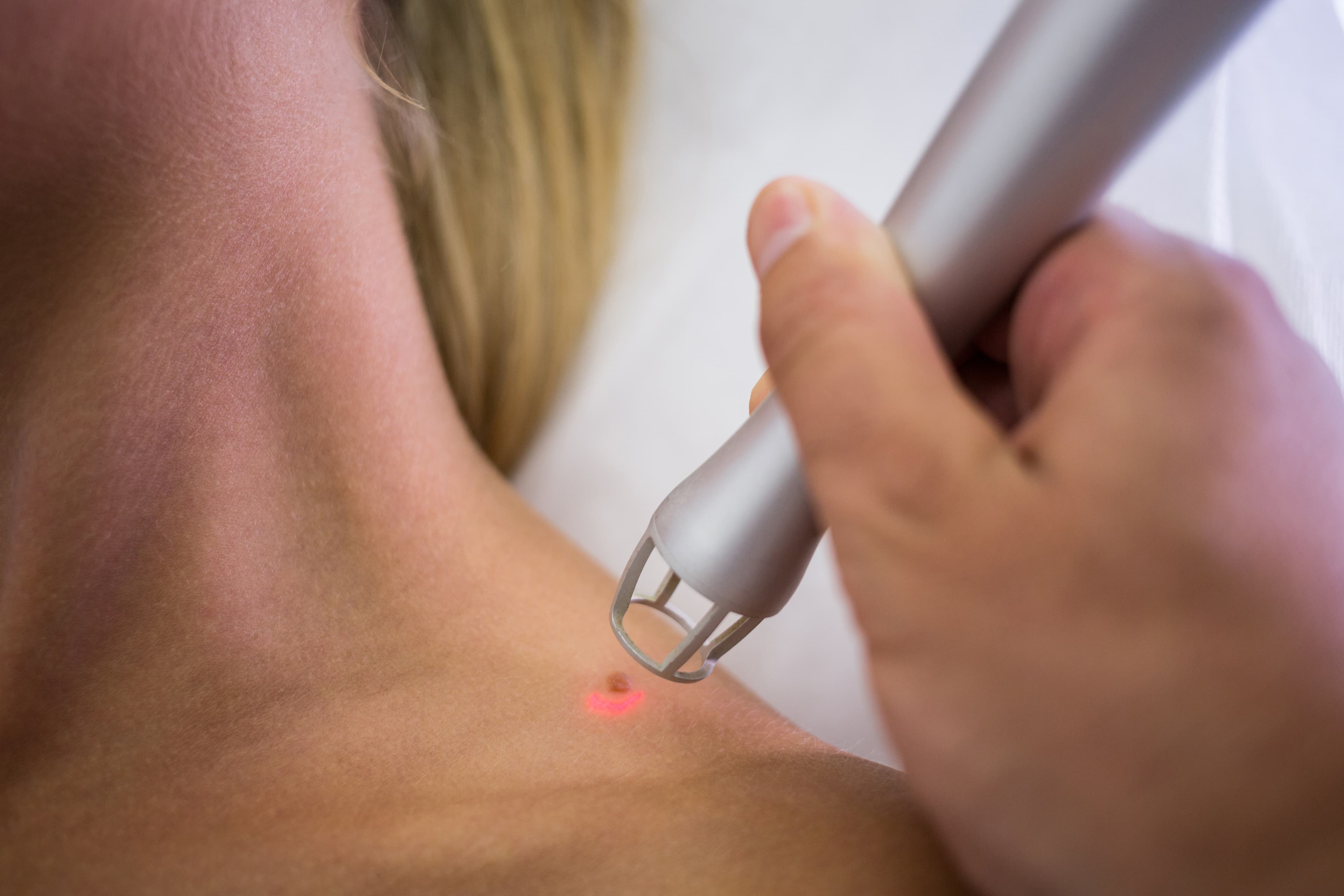 Skin Tag Removal