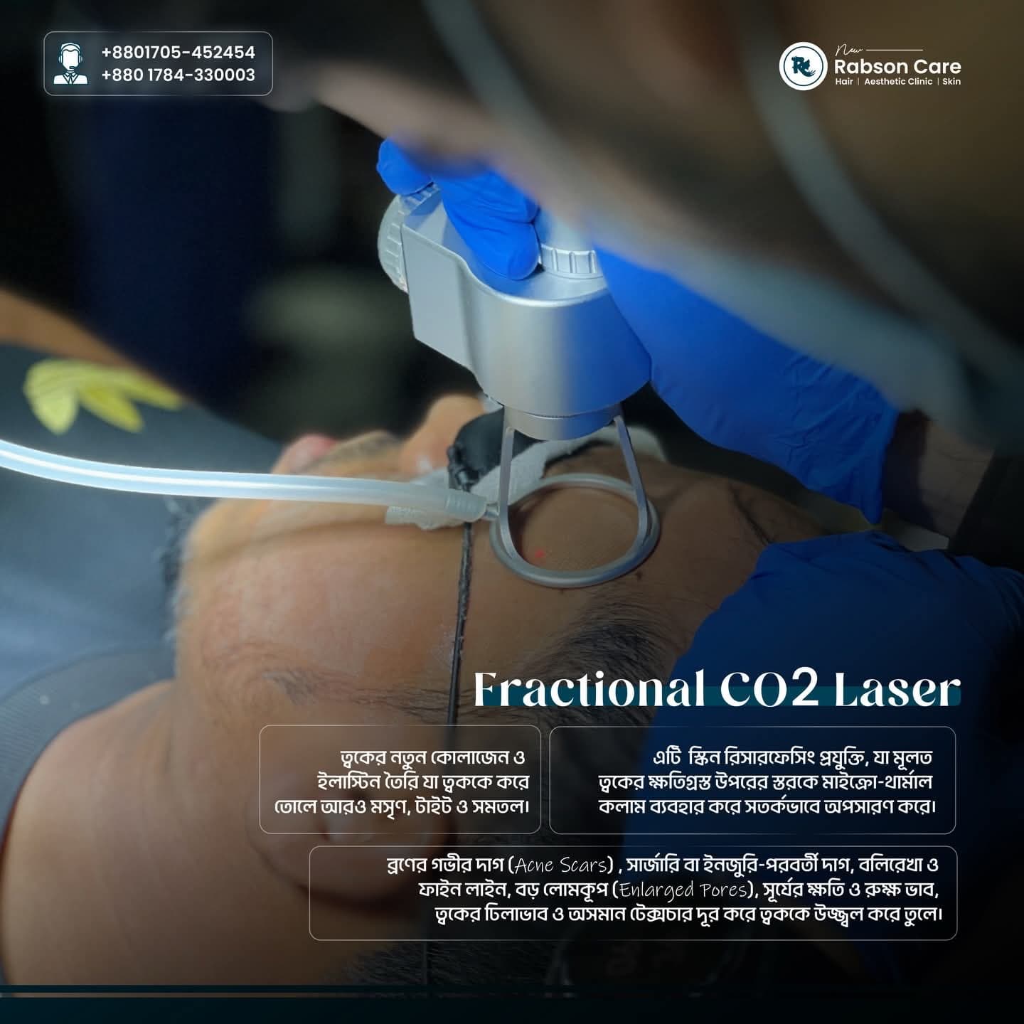 CO2 Laser (Fractional Laser)