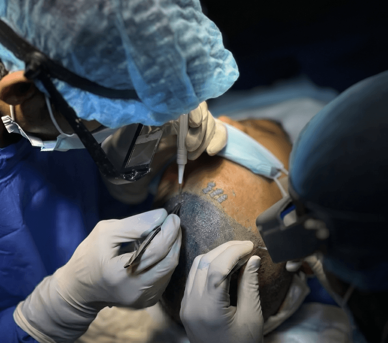 Hair Transplant (FUE, FUT, DHI)