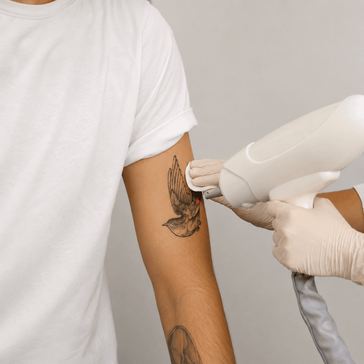 Tattoo Removing Laser