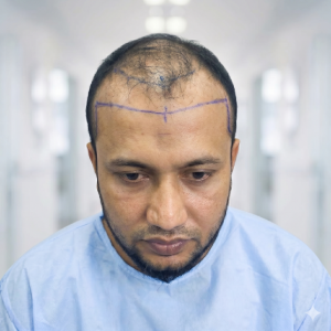 After skin rejuvenation treatment