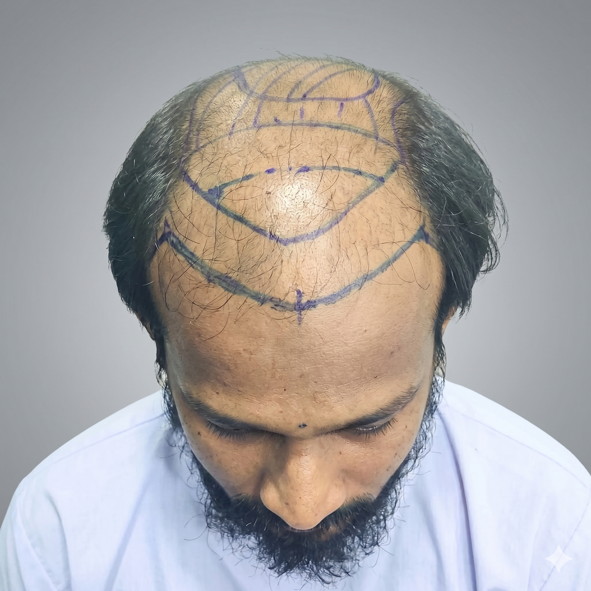 After hair restoration treatment